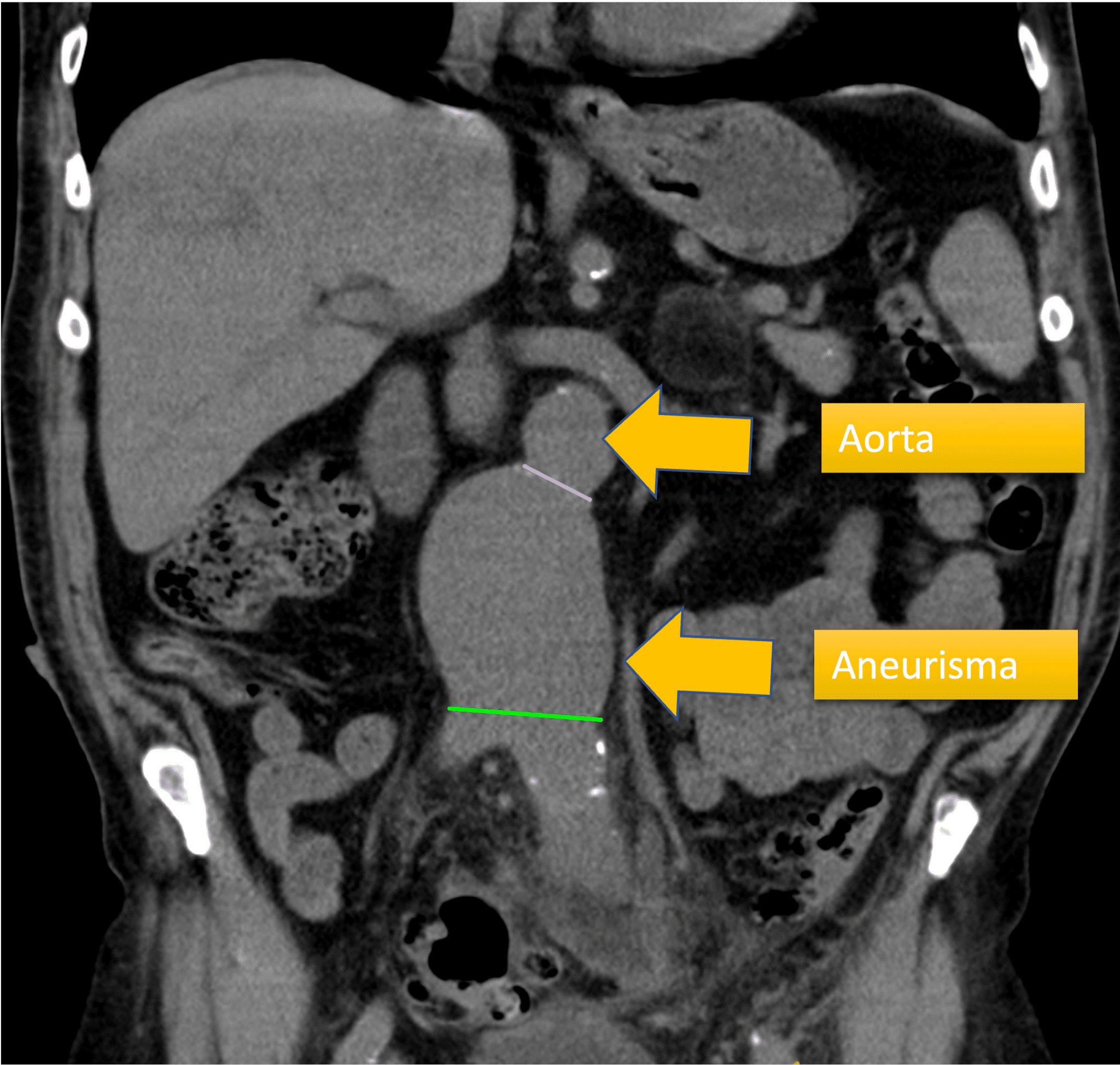 Aneurisma de Aorta Abdominal 🎈- Clinica Vena Sana