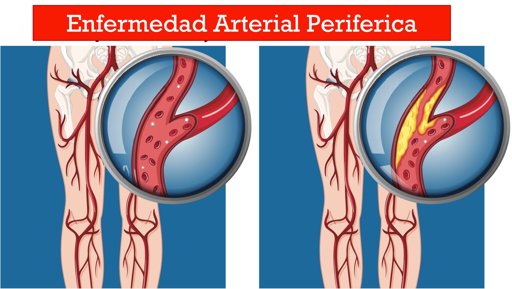 Enfermedad Arterial Periférica Clinica Vena Sana