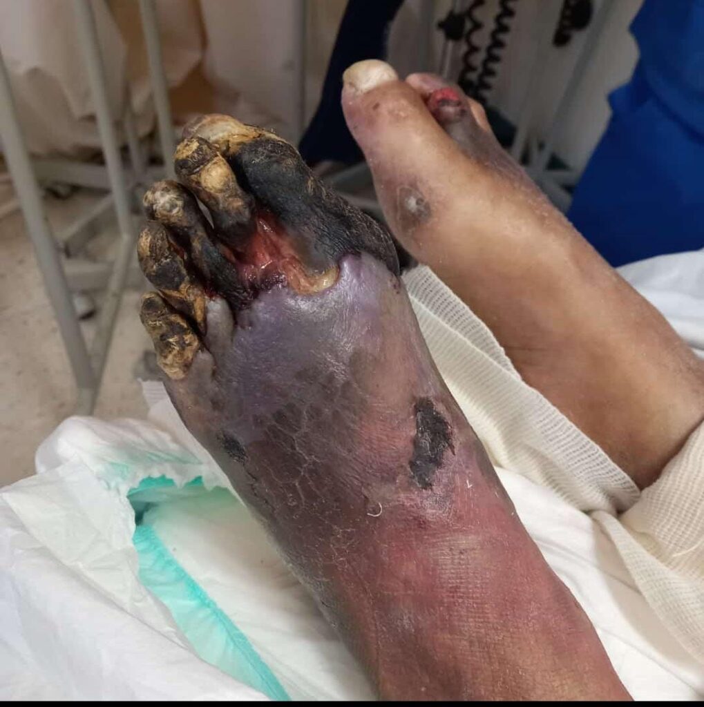 Imagen de una pierna con gangrena en un pie diabético avanzado. La zona afectada por la gangrena presenta un color oscuro y textura dura y seca. Se observa una inflamación alrededor de la herida en el pie